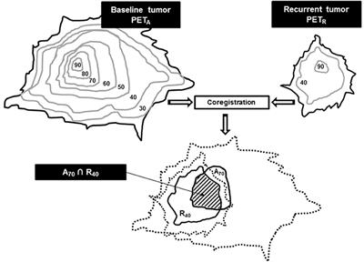 Correlation Between FDG Hotspots on Pre-radiotherapy PET/CT and Areas of HNSCC Local Relapse: Impact of Treatment Position and Images Registration Method